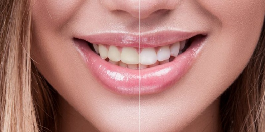 quickly whiten your teeth